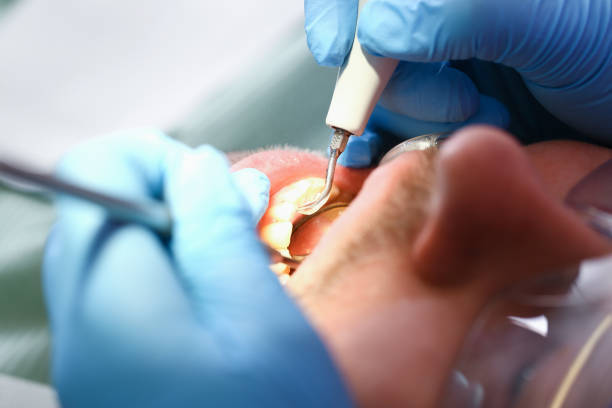 Best Emergency Dentist for Lost Fillings or Crowns in Morrisville, VT